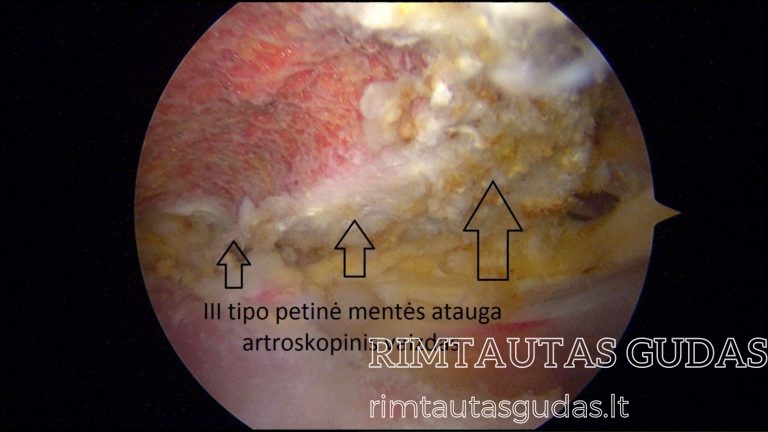 III tipo akromionas 1