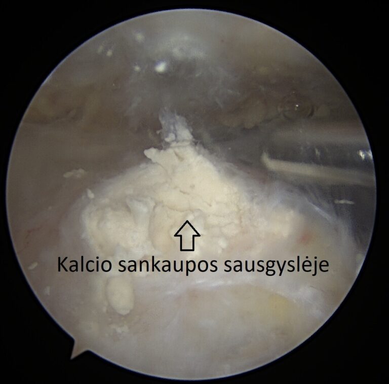 kalkėjantis tendinitas s