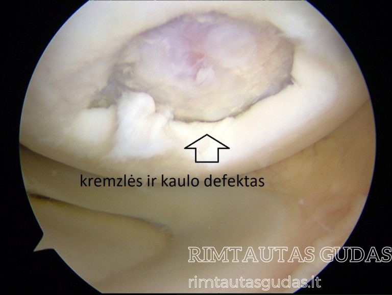 kremzlės defektas ir kaulo 2