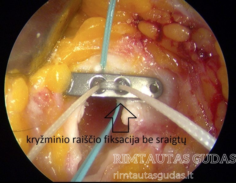 kryžminio raiščio fiksacija