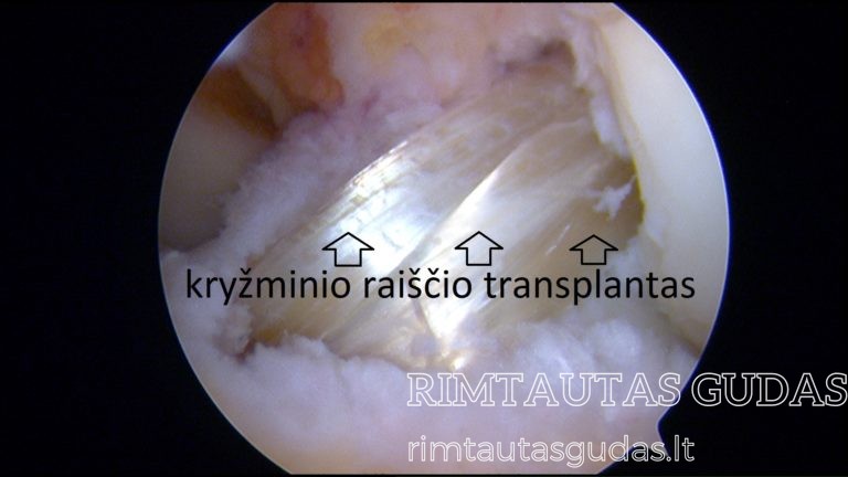 kryžminio raiščio transplantas