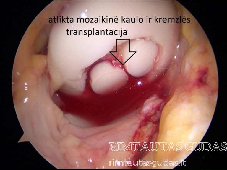 mozaikinė kremzlės transplantacija