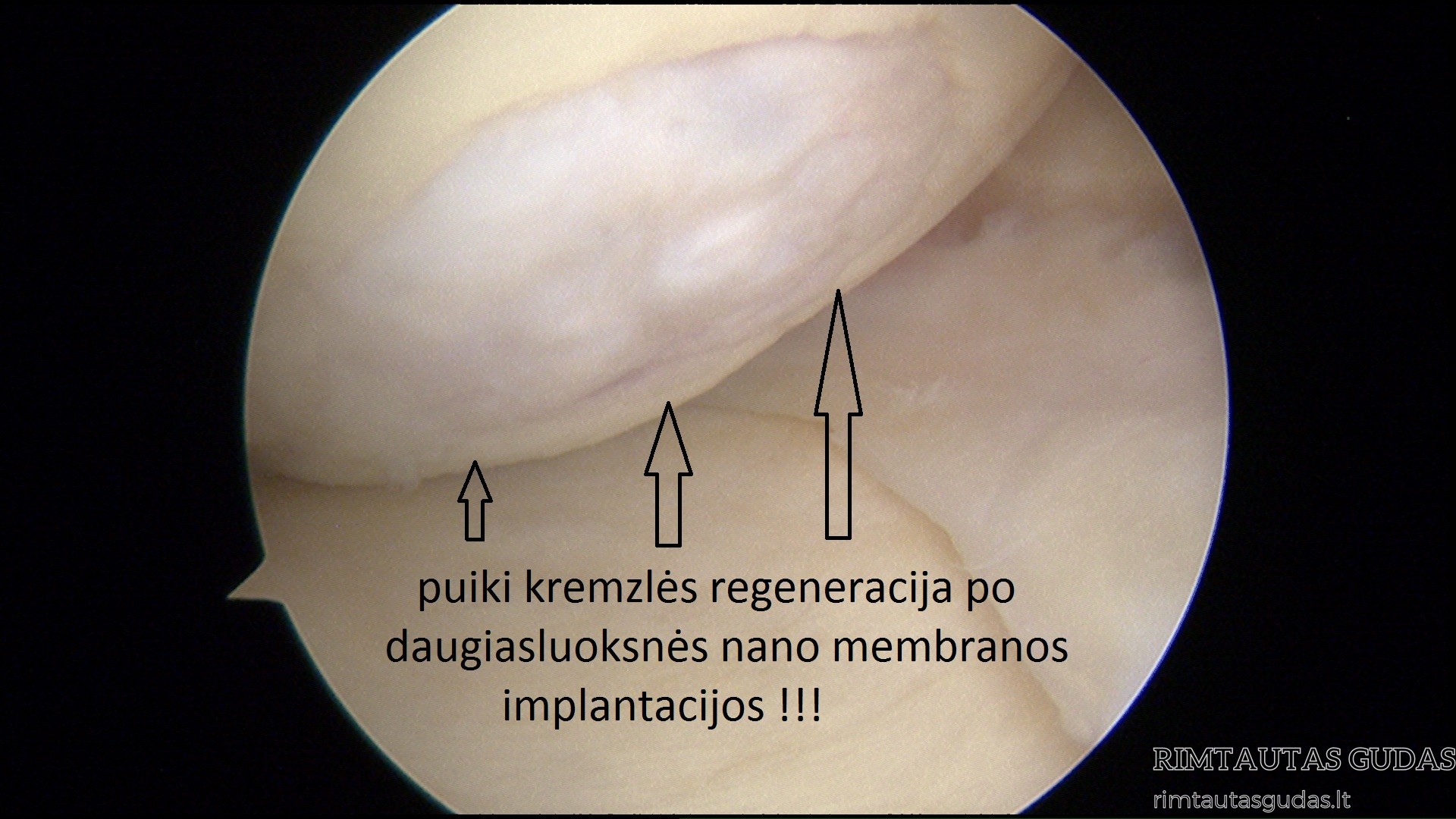 Chondroplius membrane