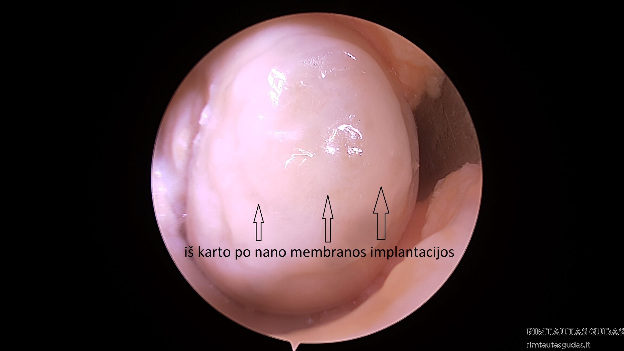 nano membrana po implantacijos scaled