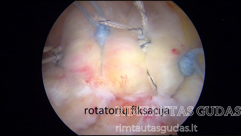 rotatorių fiksacija