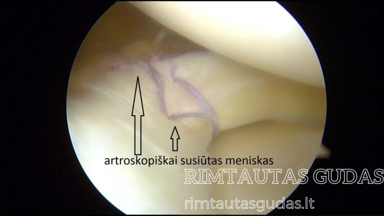 susiūtas išorinis meniskas