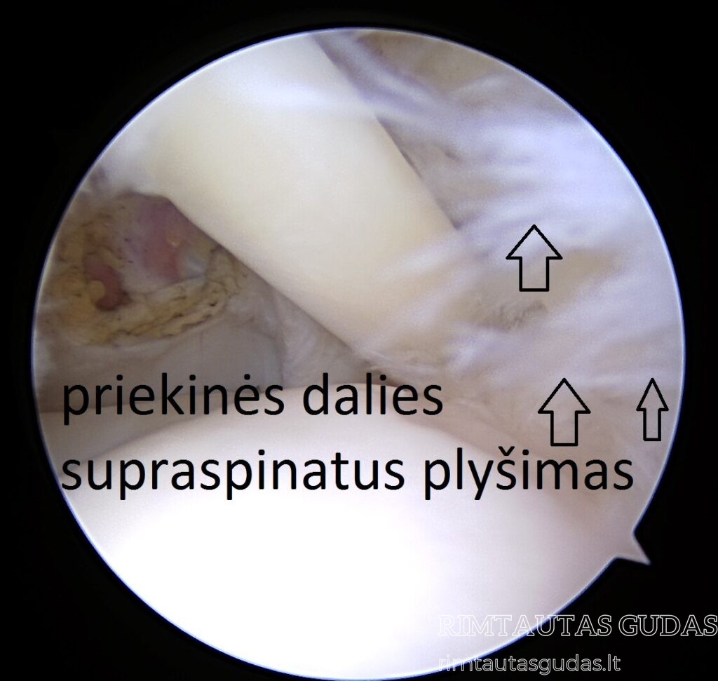 Dalinis peties rotatorių ir bicepso sausgyslės plyšimas