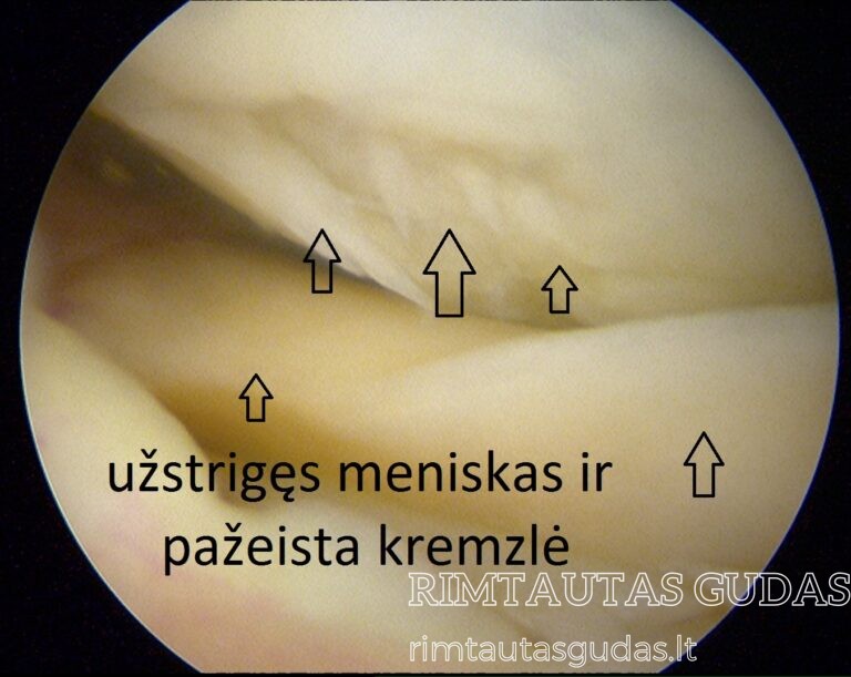 užstrigęs meniskas