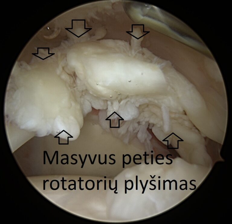 Masyvus peties rotatorių plyšimas