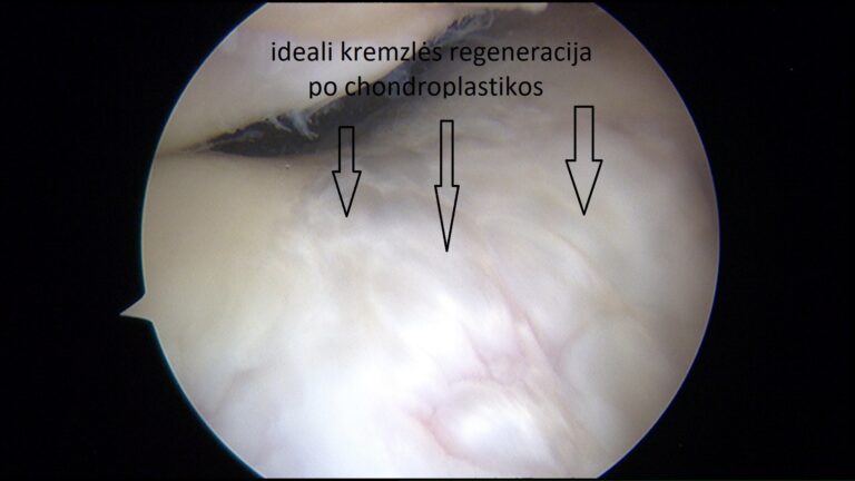 po kremzlės chondroplastikos