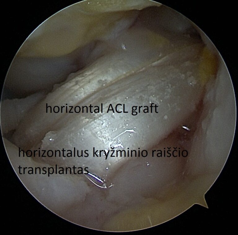 ACL graft