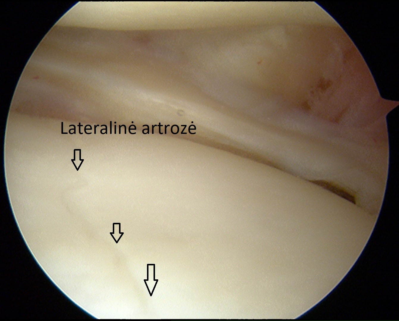 lateralinė artrozė