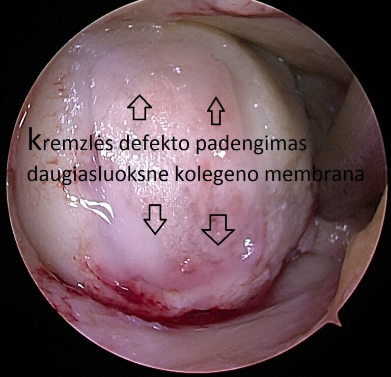 MaioRegen chondroplus membrana