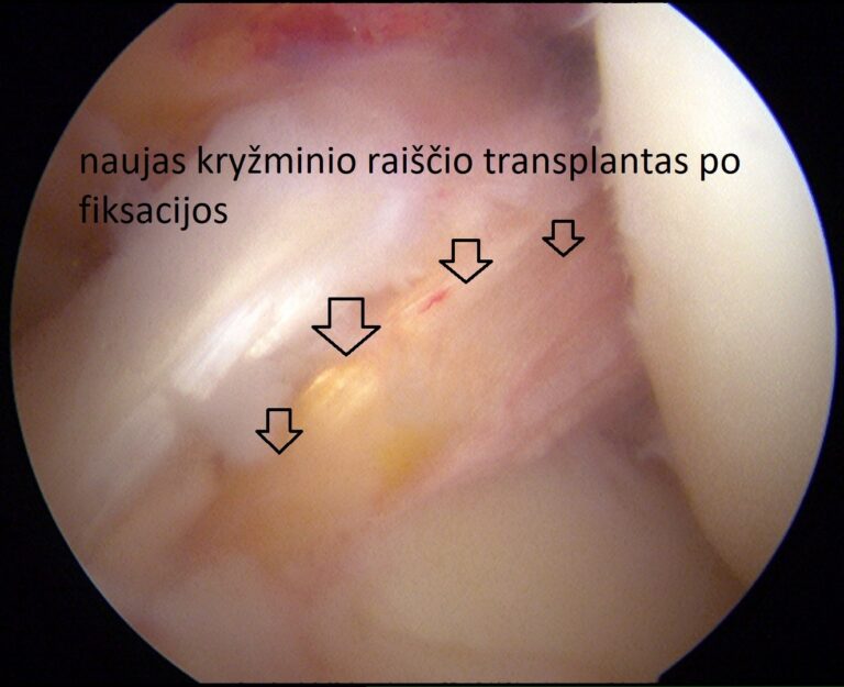 kryžminio raiščio transplantas