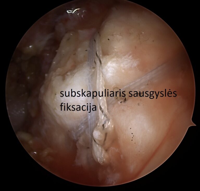 subskapuliaris sausgyslės fiksacija