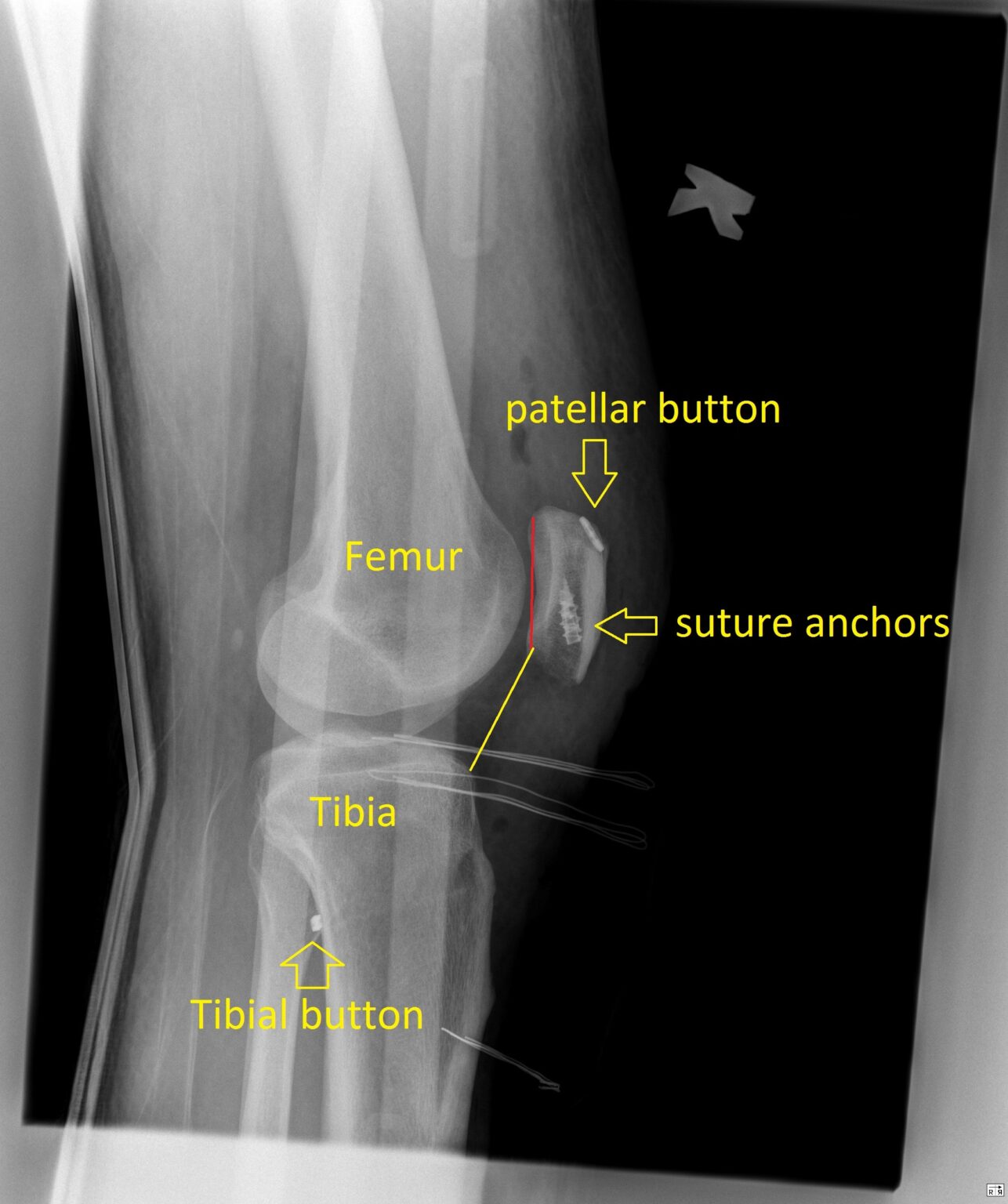 Patella Tendon Rupture And Repair With Augmentation And Suspensory Fixation Rimtautasgudas Lt