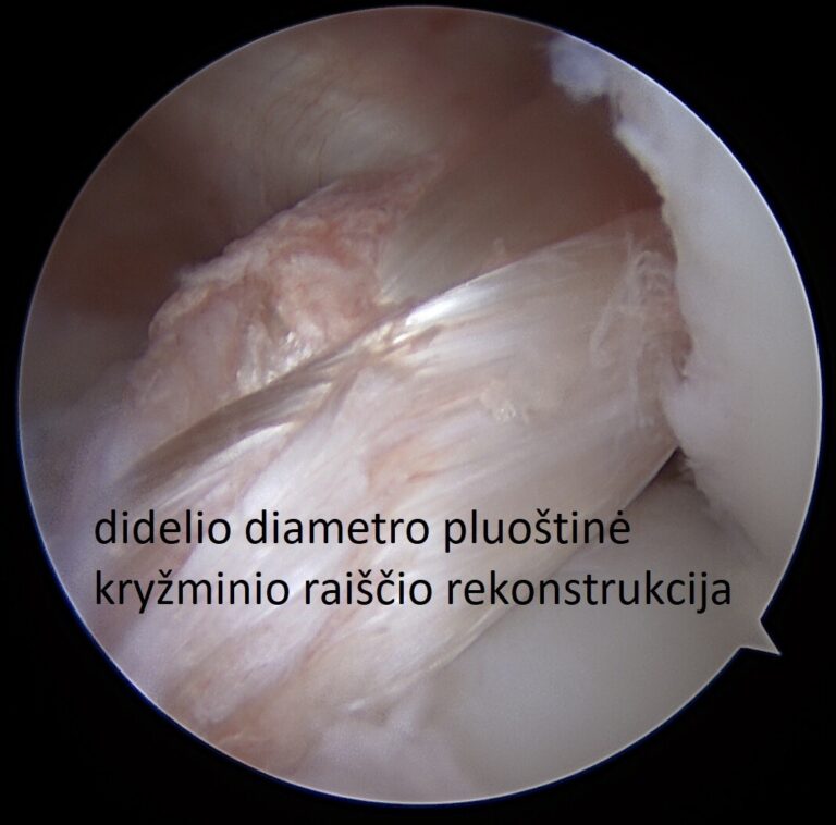 kryžminio raiščio rekonstrukcija