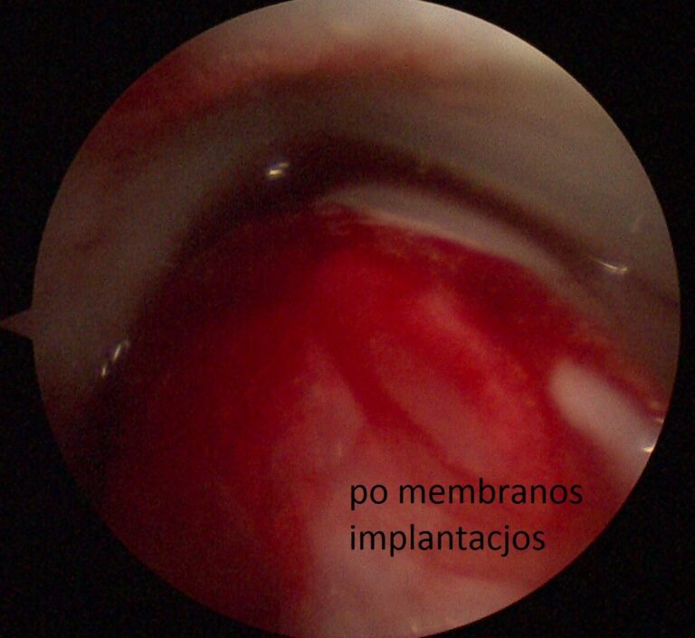 membranos implantacija čiurna
