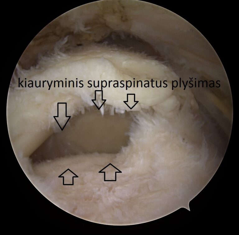 supraspinatus kiauryminis plyšimas