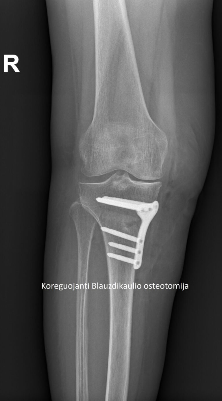 HTO osteotomija scaled