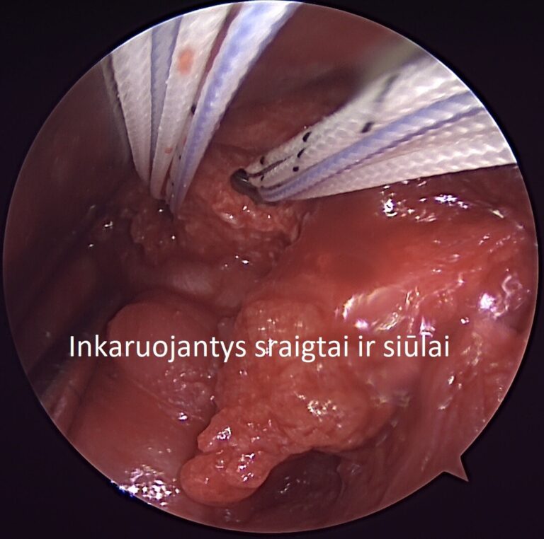 inkaruojantys sraigtai