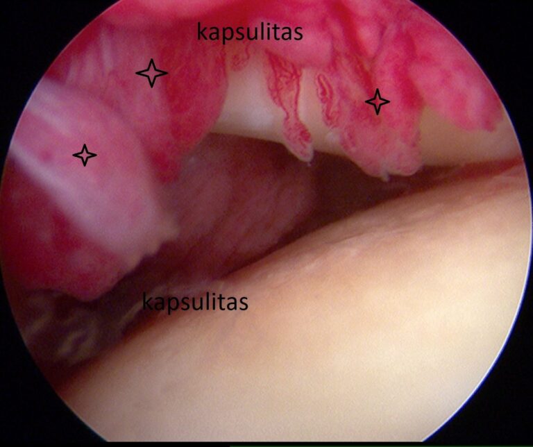 kapsulitas