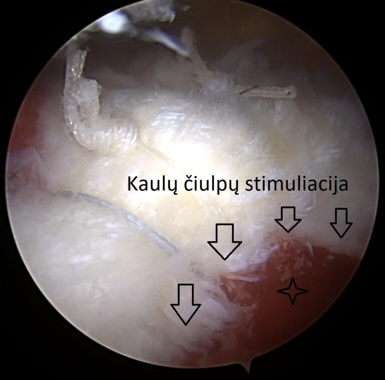 kaulų čiulpų stimuliacija