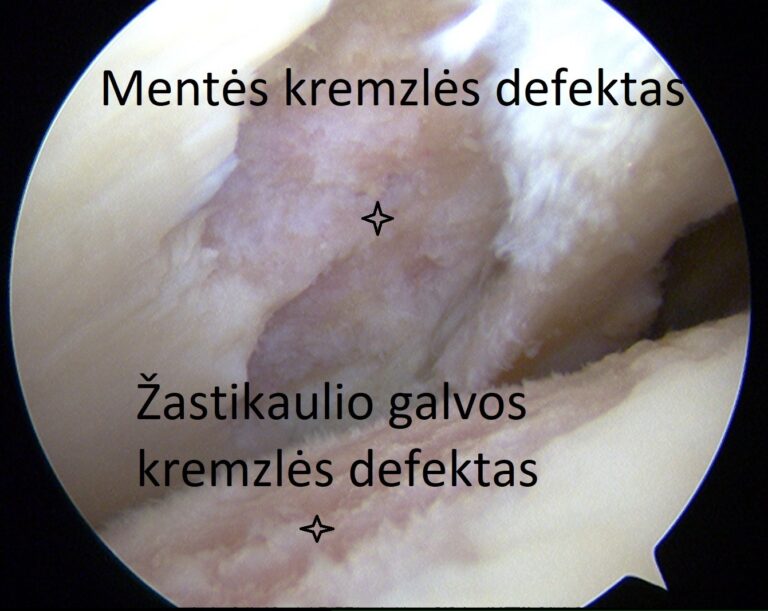 peties kremzlės defektas