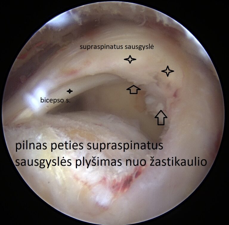 supraspinatus plyšimas