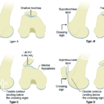 Dejour classification of trochlear dysplasia