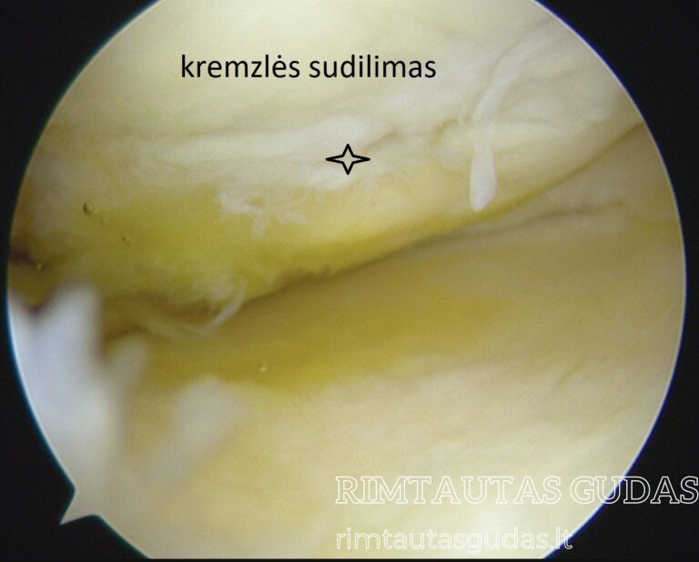 kremzlės sudilimas