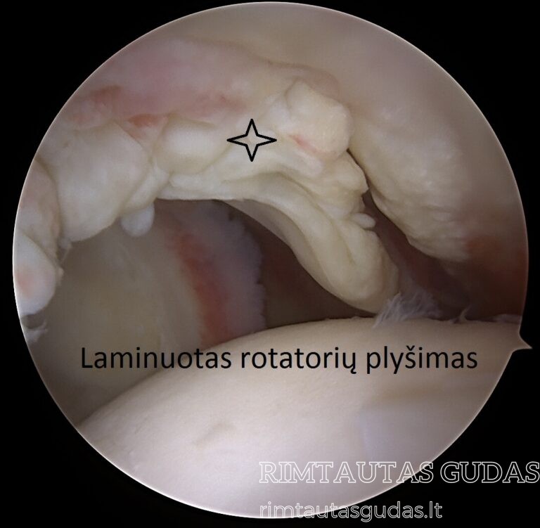 laminuotas rotatorių plyšimas