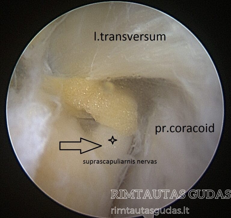 supraskapuliaris