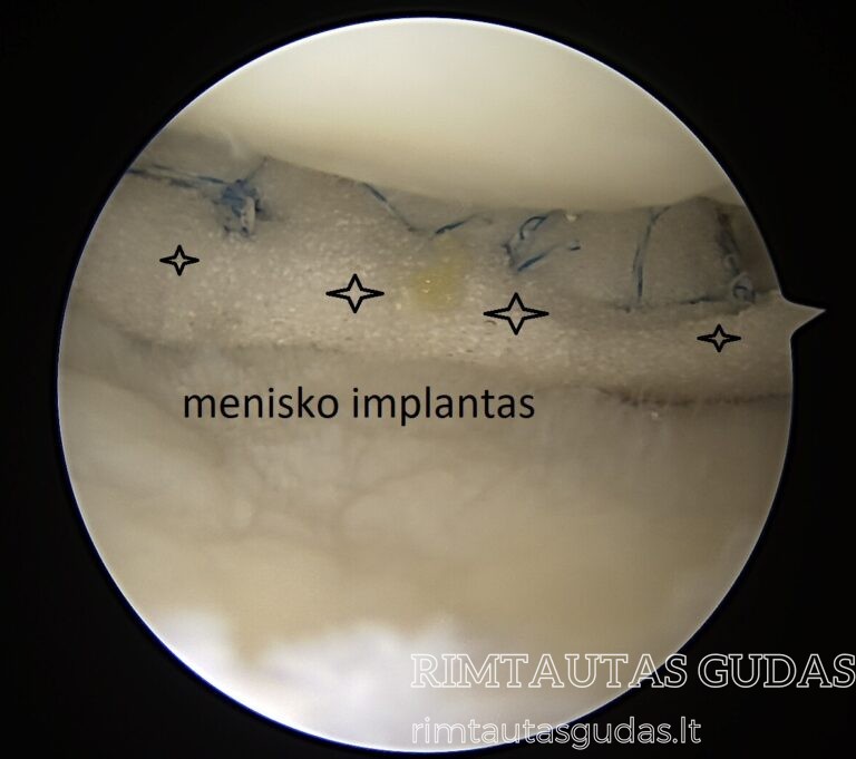 menisko implantas