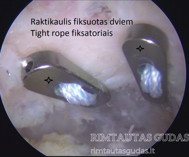 raktikaulio fiksacija