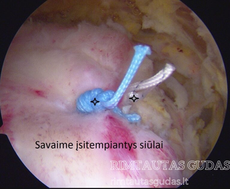 savaime įsitempiantys siūlai