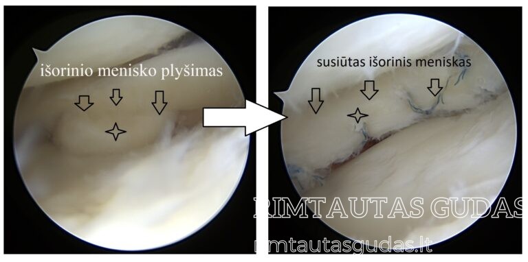 degeneracinis menisko plyšimas