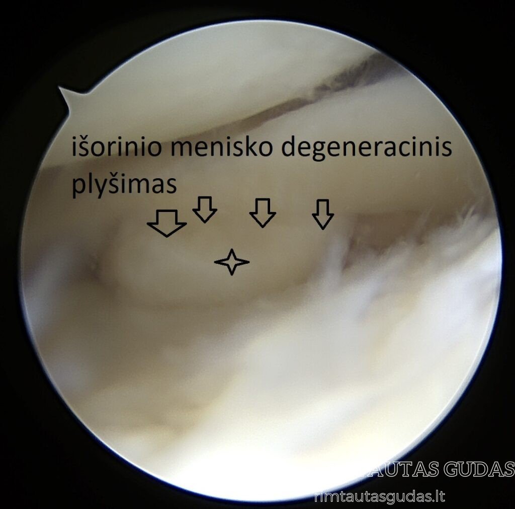 Meniskų plyšimai, meniskų degeneracija, meniskų gydymas, artroskopinės operacijos 4 degeneracinis menisko plyšimass