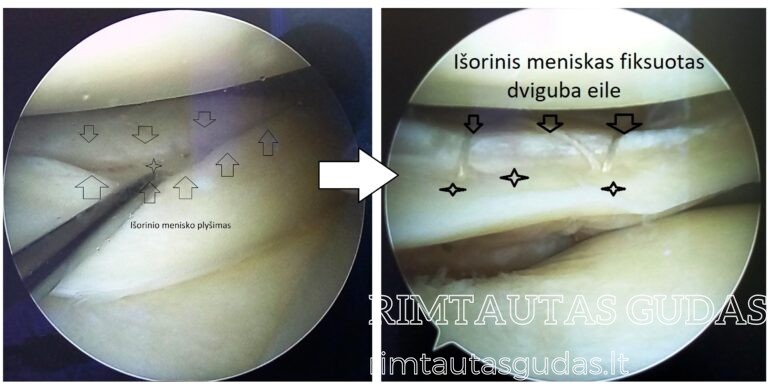meniskai siuvimas plysimo