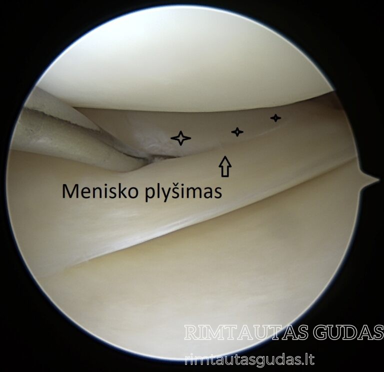 menisko plyšimas