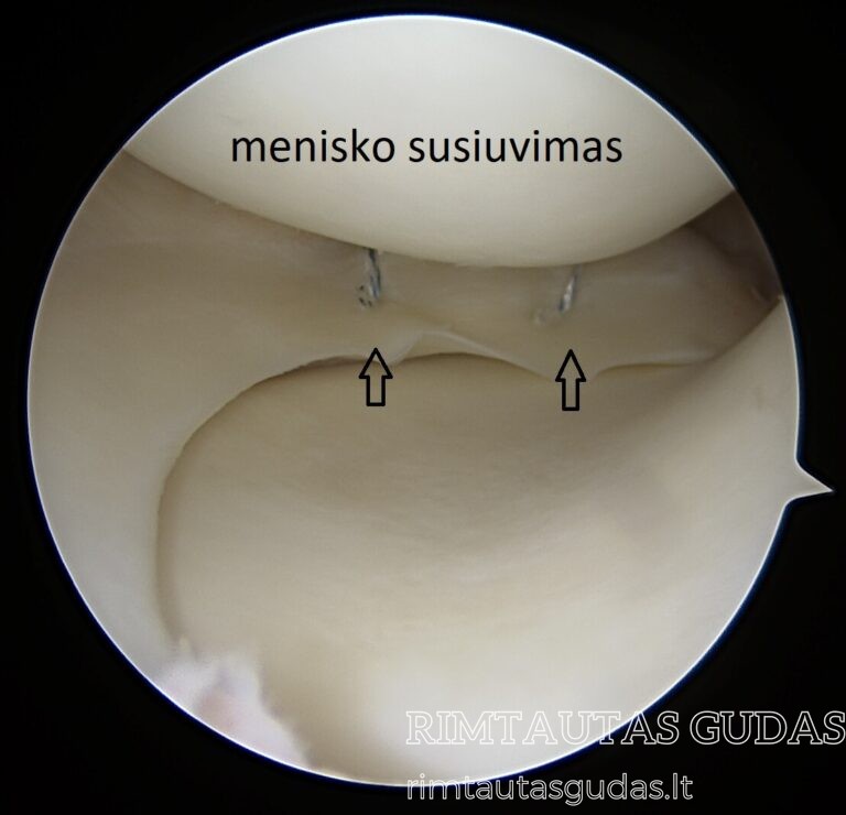 menisko susiuvimas 3