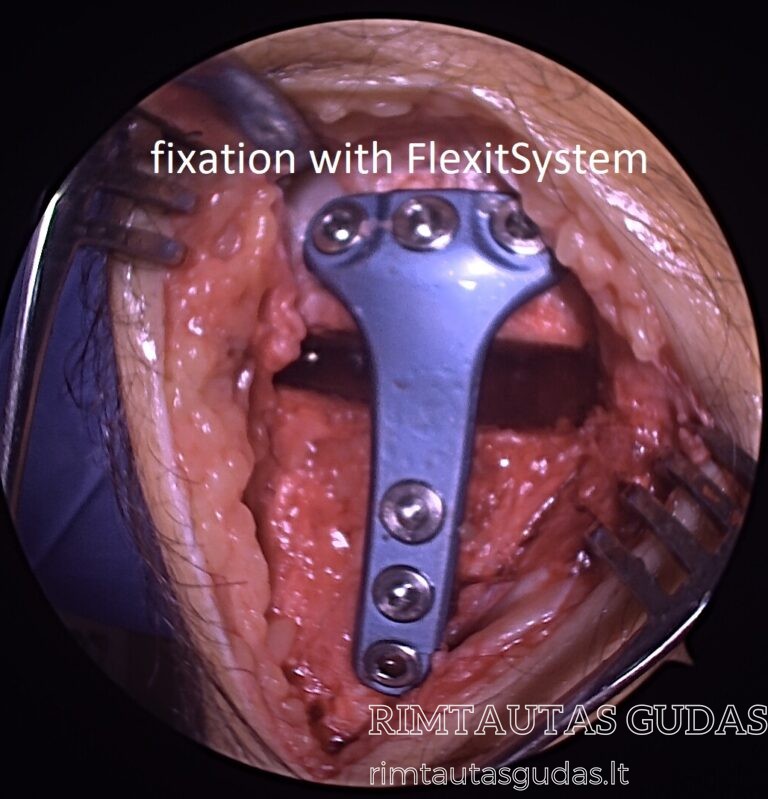 HTO fixation