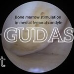 MFC bone marrow stimulation