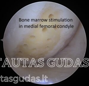 MFC bone marrow stimulation