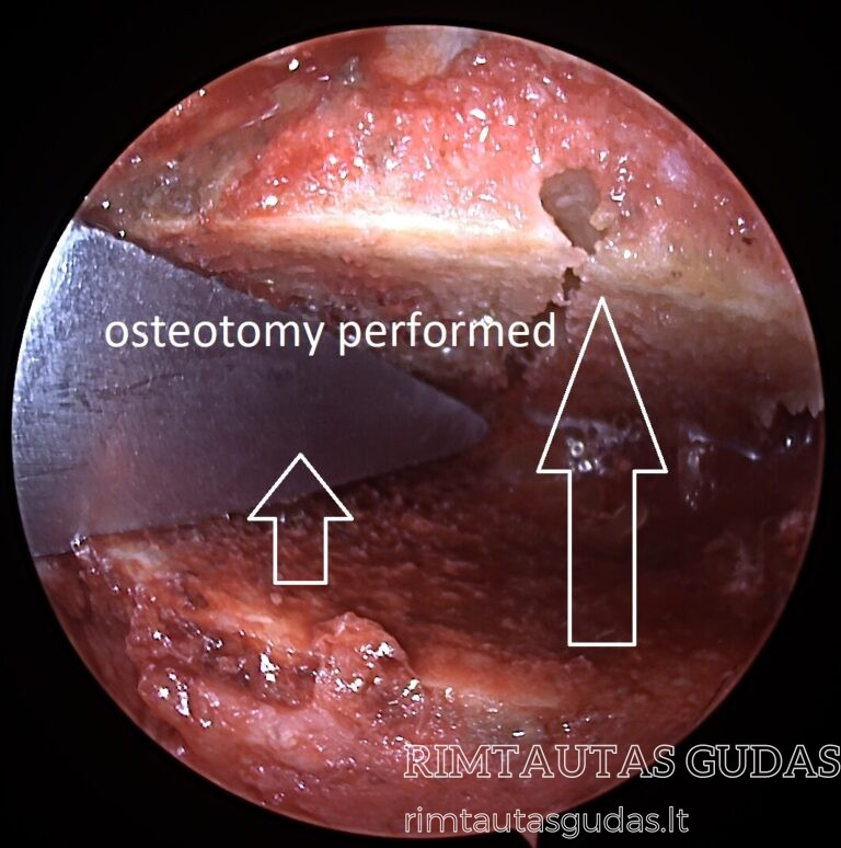 osteotomy performed