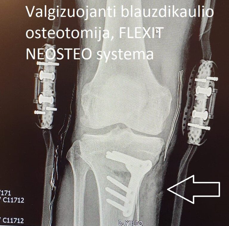 HTO osteotomija