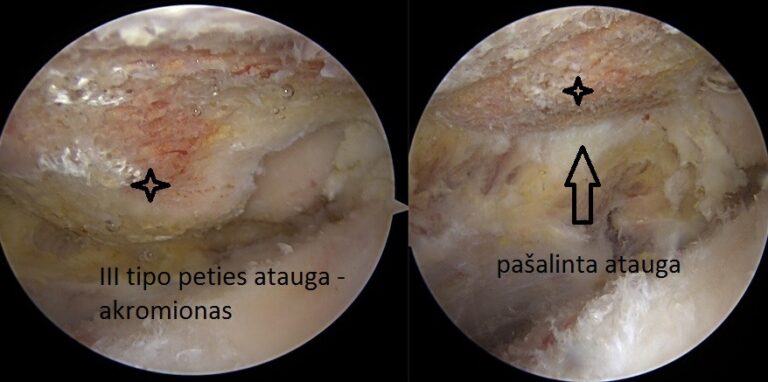 III tipo akromionas