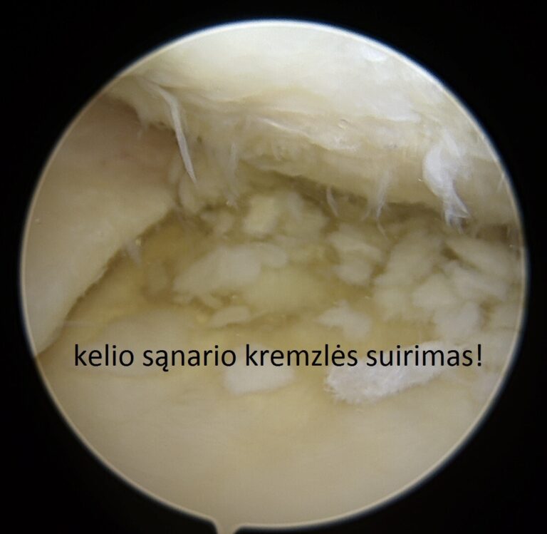 kremzles suirimas