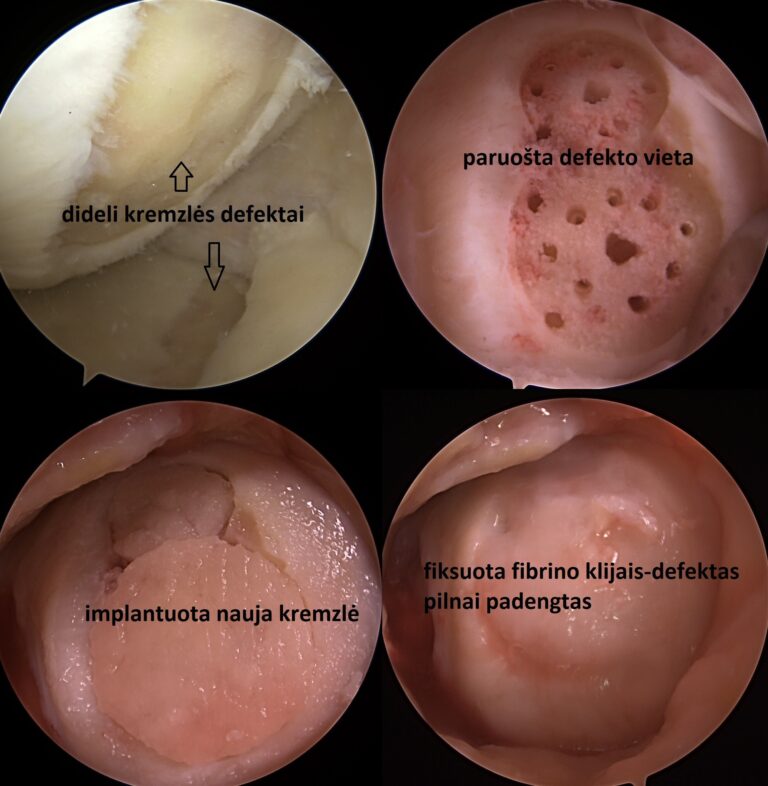 Finceramica chondroplus