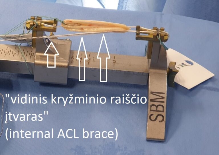 internal brace ACL